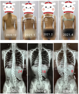 【龙脊康脊柱课堂】脊柱侧弯如何早期发现和筛查?