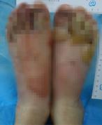 糖尿病患者冬季如何预防糖尿病足 警惕保暖烫伤风险