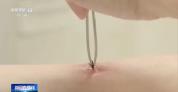 医生从患者身上拔出17只蜱虫 蜱虫病需警惕