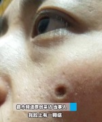 女子药水点痣脸上留大坑直呼崩溃 ​医生提醒