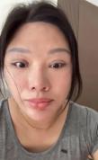 女子割双眼皮后无法闭眼落下9级伤残 整形悲剧引发关注