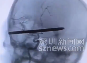 除草机弹起18cm钢钻刺穿男子头颅：医生手术4小时取出