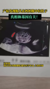 产检发现胎儿在妈妈腹中拉肚子 罕见基因缺陷所致