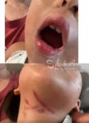 3岁半女童疑遭男老师暴力喂食受伤 涉事教师已被拘留