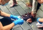 男子腿部血管突然爆裂血流一地 静脉曲张引发急症