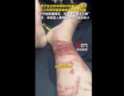 男子被沙蜇蜇伤5小时后呼吸困难 海边度假险送命