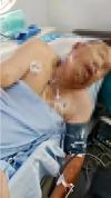 七旬夫妻遭马蜂围攻进了ICU 200多处蜇伤触目惊心