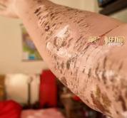 小伙请假回家过节 第1天被毒蛇咬伤 假期变医院之旅