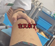 男子抽关节积液抽出喷泉效果 网友看呆
