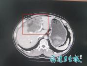 男子右上腹反复作痛查出虫癌 医生：有这些情况尽早就诊