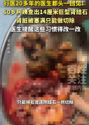 女子不渴不喝水长出巨型结石 医生：行医20多年头一回见