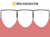 塞牙可能是你的牙在喊救命 牙缝变大背后的警报