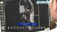 半歲寶寶反復咳體內(nèi)取出17厘米巨瘤 醫(yī)生介紹
