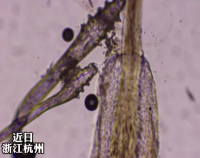 女子种睫毛后螨虫侵入眼睑 医生回应