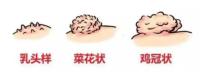 身上长这种疙瘩千万别抠 可能是尖锐湿疣