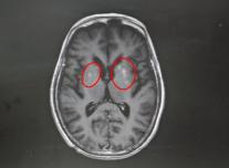 高血糖“烧坏”老人运动功能协调区 警惕非酮症高血糖性偏侧舞蹈症