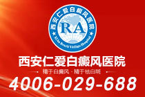 排名关注！西安白癜风去哪家医院治疗"口碑载道"局限型白癜风的发病因素