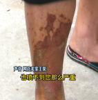 男子拆快递被烧脸，商家回应：我怀疑你自残