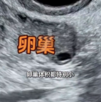 26歲女子每天熬夜致卵巢早衰絕經(jīng) 醫(yī)生建議女性10點(diǎn)半前睡覺(jué)