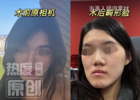 去醫(yī)院看牙被建議做手術后毀容 女孩找到涉事醫(yī)院以及當?shù)匦l(wèi)健委進行維權