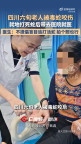 女子被咬傷打死蛇后帶蛇就醫(yī) 為精準救治立功