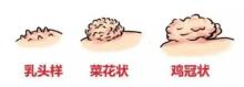 身上长这种疙瘩千万别抠 可能是尖锐湿疣