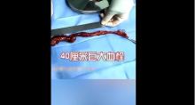 大爷静脉曲张 医生取出超大血栓 警惕血栓风险
