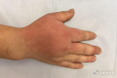 男子被石头鱼刺伤半小时手肿如熊掌