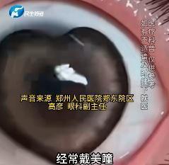 女子眼痒竟从眼睛里取出两条活虫 结膜吸吮线虫作祟