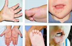 麻疹、水痘、手足口病，何时容易传染？