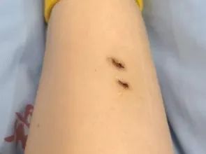 女子簡述在酒店被毒蛇咬傷 后遺癥持續(xù)兩年