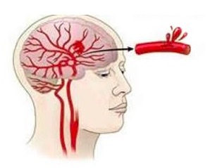 颅内出血的症状 脑痉挛是怎么引起的