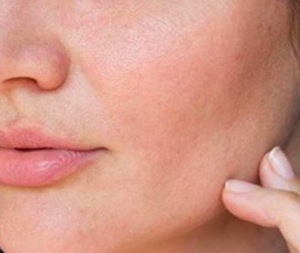 如何减轻皮肤过敏 脸过敏怎么查过敏原