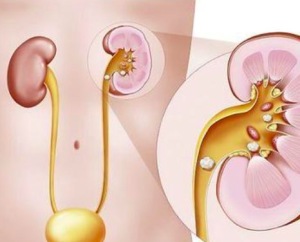 肾结石会导致腰部酸胀吗 男性尿痛什么原因引起的