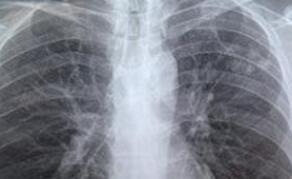 肺结核的早期症状 怎么治疗肺结核