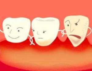 干槽症是什么 拔牙干槽症症状有哪些