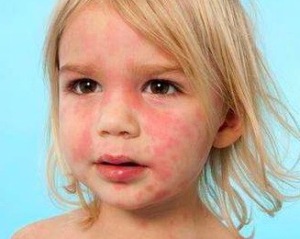 小孩荨麻疹症状 小孩荨麻疹症状会发烧吗