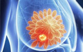 乳腺增生会恶变为乳腺癌吗？​哪些女性易患乳腺恶性肿瘤