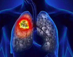 肺癌的肺外症状有哪些？ 肺癌早期症状易与感冒混淆