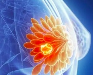 如何预防乳腺癌有效 影响妇女患乳腺癌发病的因素有哪些
