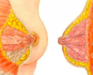 大胸女人易得癌？ 哪些食物防乳腺癌少不了
