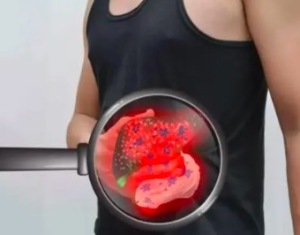 肝炎病人如何防止肝癌的发生 预防肝癌发霉食品切忌食用