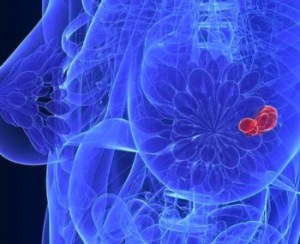 ​如何面对乳腺癌的复发和转移？ 乳腺增生病与乳腺癌在发病因素有哪些