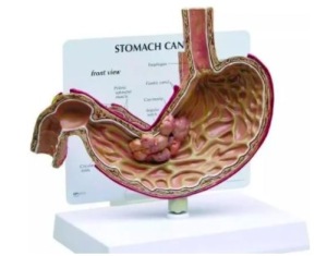 治疗胃癌的方法是什么 胃癌另类治疗方法有哪些