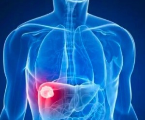 肝癌的治疗方法有哪些 肝癌的治疗进展有哪些方面