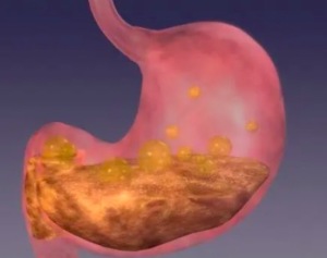 胃癌患者术后应警惕并发症的发生 吃饭不规律会得胃癌吗