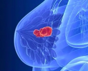 关于乳腺癌有哪些谎言 如何预防遗传性乳腺癌