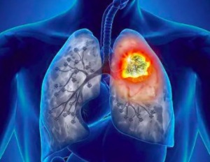 肺癌病人胸腔反复积液怎么办 晚期肺癌选放射免疫靶向治疗