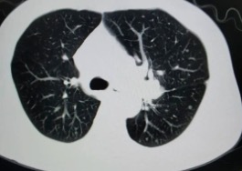 肺部结节与肺癌有什么关系 肺结节跟肺癌有什么区别