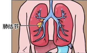 为何近两年查出肺结节的人这么多 查出肺结节后要怎么处理？